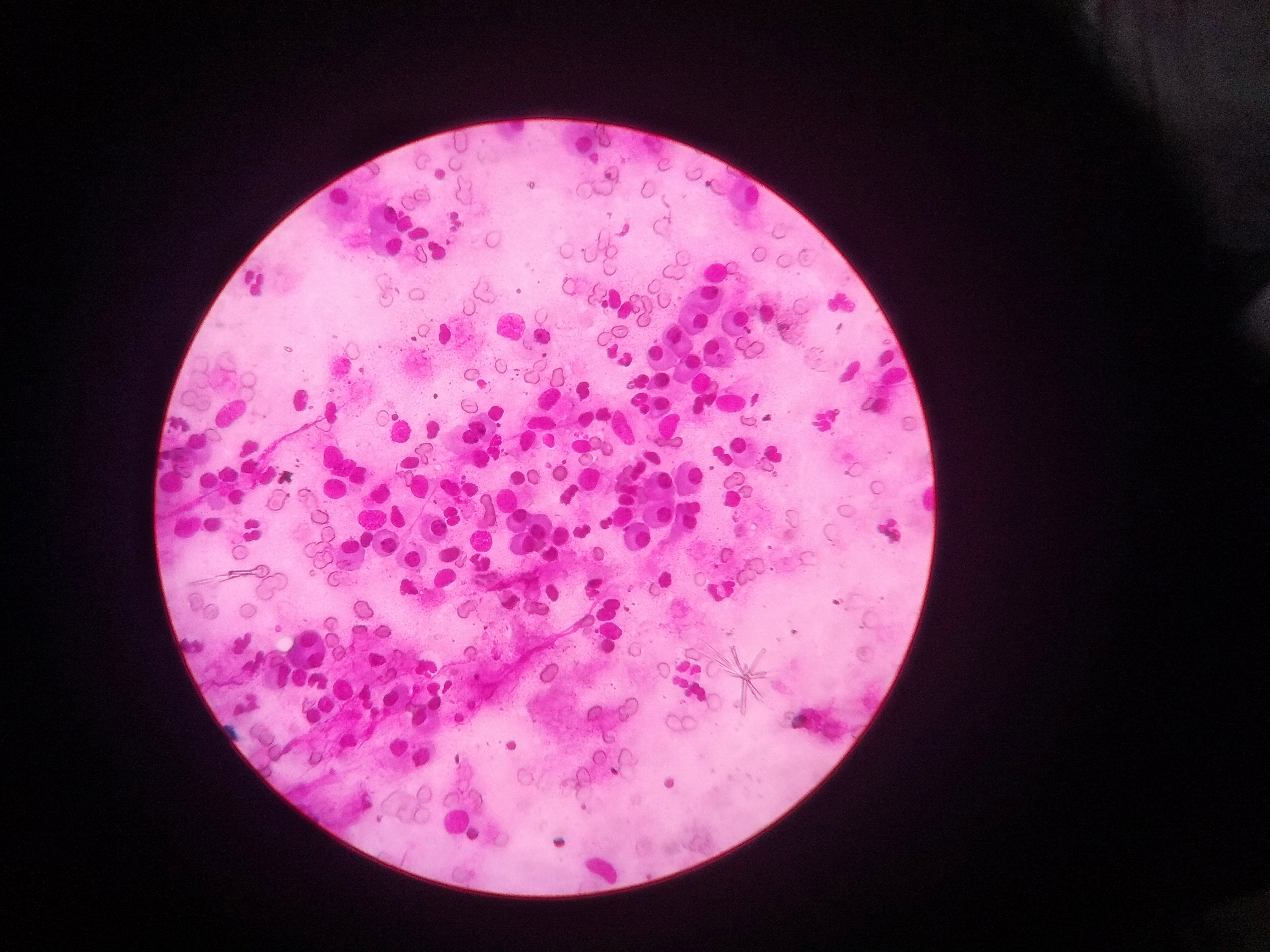 Plasma Cells In Supraclavicular Swelling FNAC
